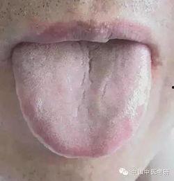 青紫舌图片,中医视角下的舌诊奥秘